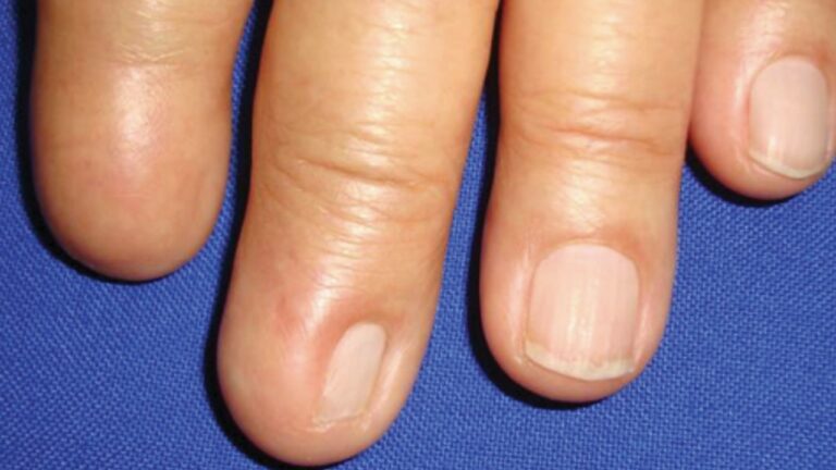 Anoniquia congénita o ‘las uñas fantasmas’